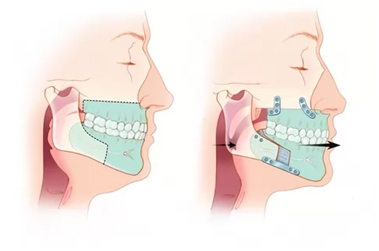 maxillomandibular